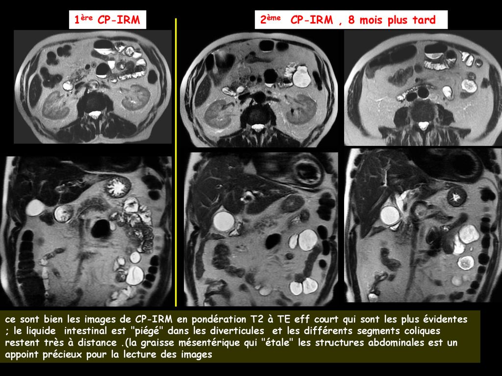 Homme 83 ans en excellent état général porteur d une lithiase